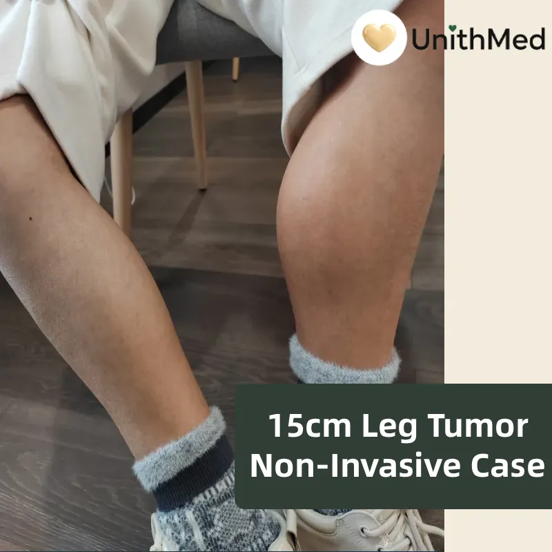 15cm Leg Tumor Non-Invasive Case